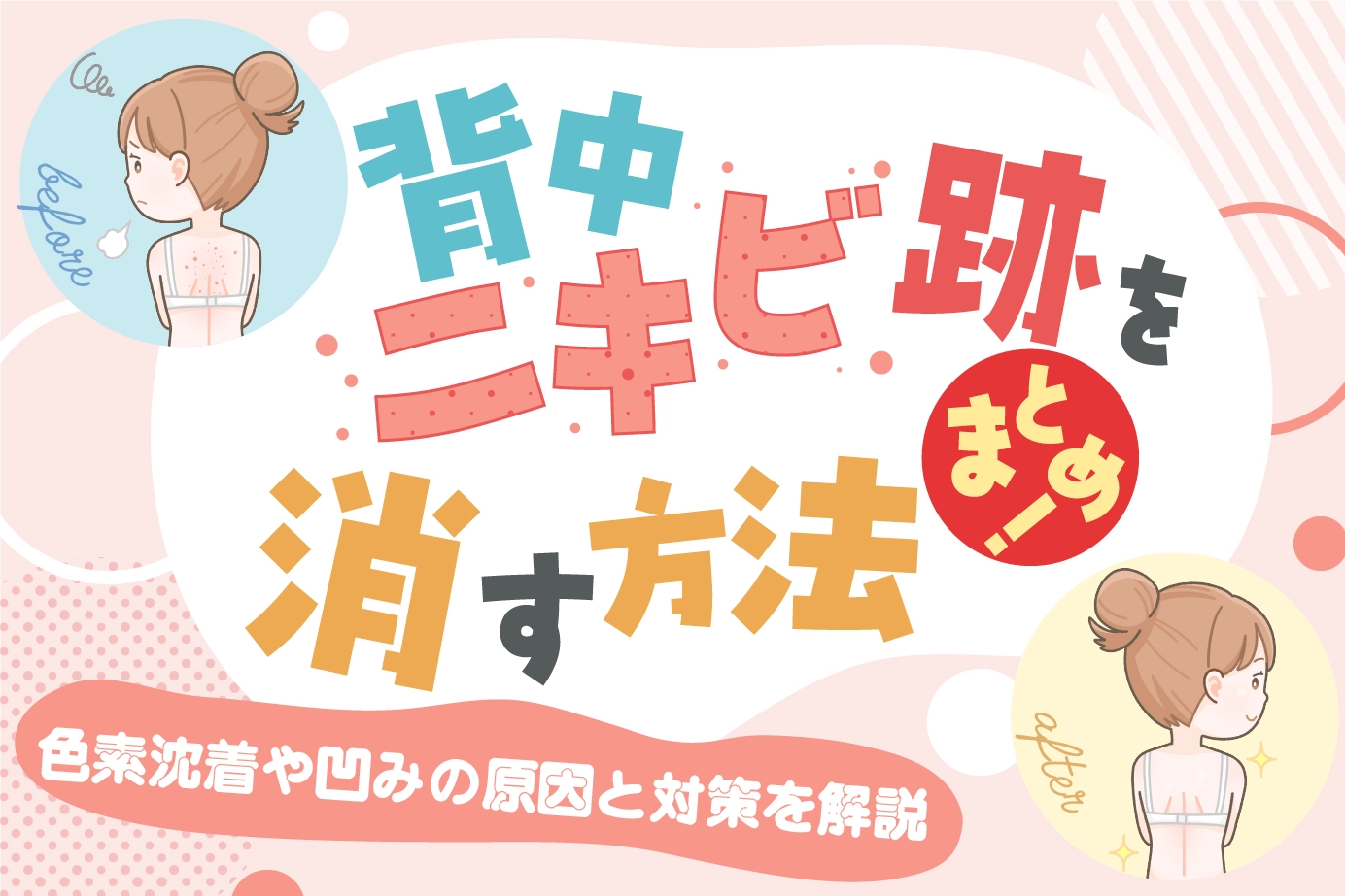 背中ニキビ跡を消す方法まとめ!色素沈着や凹みの原因と対策を解説